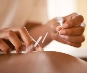 Body Acupuncture